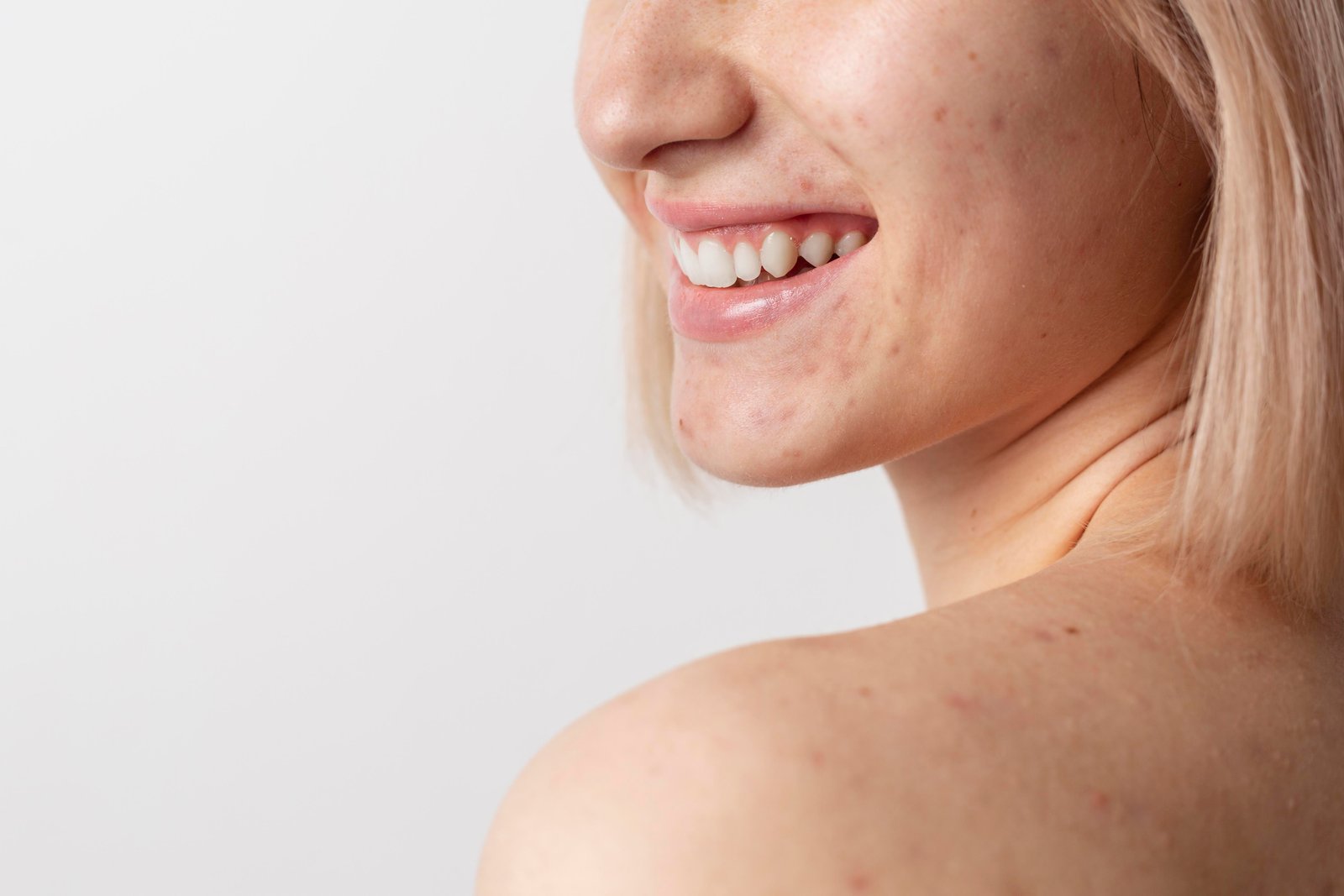 Cicatriz de Acne